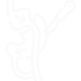 gastric-bypass